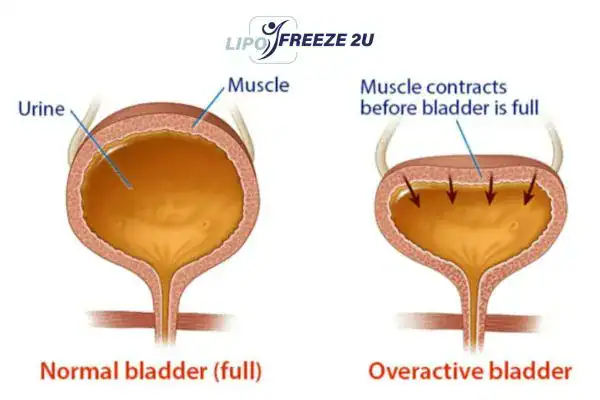 diagram of overactive bladder treatment Kensington