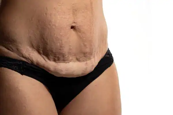 loose skin after weight loss injections Kensington
