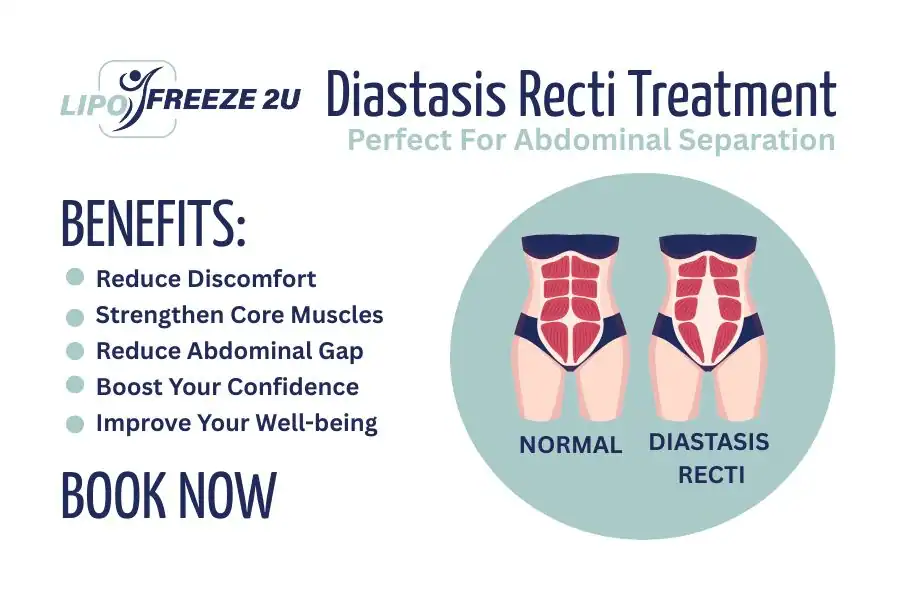 Benefits of body toning treatment Kensington for Diastasis recti