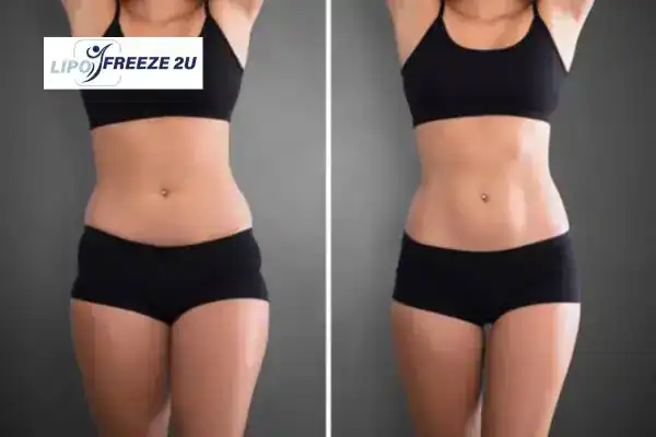 How Can LIPO FREEZE 2U Support Your Post-Pregnancy Body Recovery Kensington?