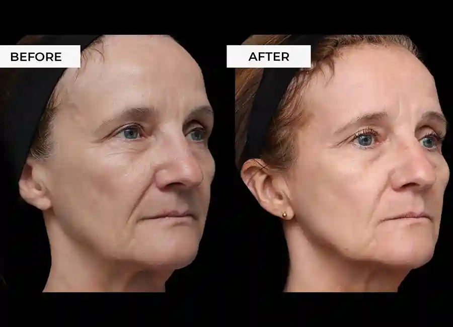 How Many RF Microneedling Sessions Will You Need to See a Difference Kensington?