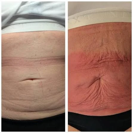 How Does RF Microneedling Improve Crepey, Thin and Uneven Skin Texture Kensington?