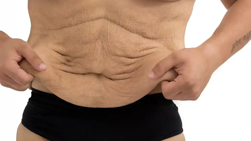 Why Does Weight Loss Medication Leave Some People With Loose or Sagging Skin Kensington?